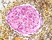 Gliomatosis peritonei,light micrograph