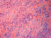 Smooth muscle cancer,light micrograph
