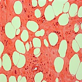 Uterine fibroid,light micrograph