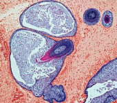 Dermoid ovarian cyst,light micrograph