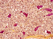 Langerhans cell histiocytosis