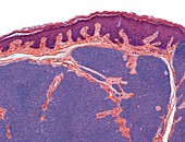 Hair follicle tumour,light micrograph