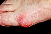 Inflamed bunion