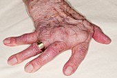 Arthritic hand