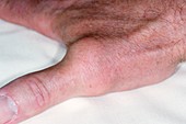 Arthritic thumb