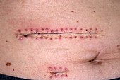 Oesophagectomy scars