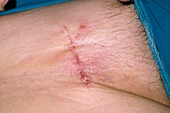 Inflamed sentinel node biopsy scar