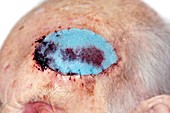 Wound dressing after skin cancer removal