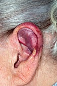 Bruised ear