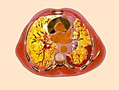 Mesothelioma lung tumour,CT scan