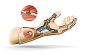 Cybernetic hand prosthesis,artwork