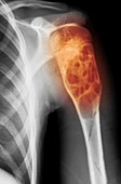 Benign bone cyst,X-ray