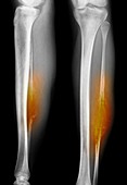 Bone tumour,X-ray