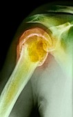 Bone tumour,X-ray