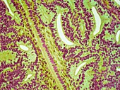 Lung cancer,light micrograph
