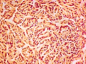 Kidney cancer,light micrograph