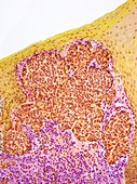 Mouth cancer,light micrograph