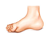 Foot deformations,artwork