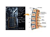 Bulging disc in the cervical spine