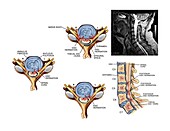 Slipped discs in the cervical spine