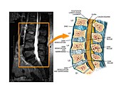 Bulging discs in the lumbar spine