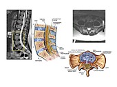 Slipped discs in the lumbar spine