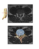 Slipped disc in the lumbar spine