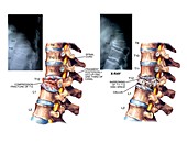 Compression fracture of thoracic vertebra