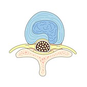 Herniated intervertebral disc