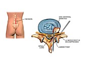 Laminectomy surgery on slipped disc