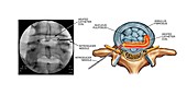 Annuloplasty procedure on damaged disc