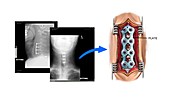 Implanting metal plate in cervical spine