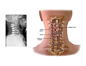 Surgery to fuse the cervical spine