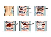 Kyphoplasty on fractured vertebra