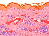 Myelomeningocele sac,light microscopy