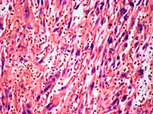 Pharynx carcinoma,light micrograph