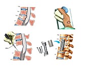Surgery to fuse the thoracic spine