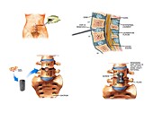 Surgery to fuse the lumbar spine