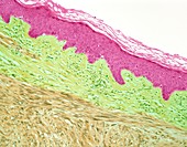 Leiomyosarcoma of skin. light micrograph