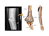 Internal fixation of fractured elbow