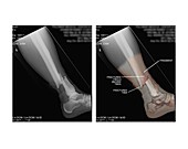 Open fracture of tibia and fibula,X-rays