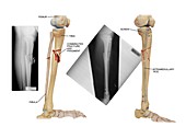 Internal fixation of lower leg bones