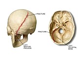Left posterior occipital skull fracture