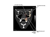 Facial skull fractures,CT scan