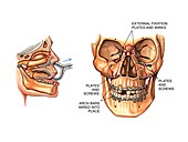 Facial fractures reduction and fixation