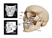 Facial skull fractures fixation