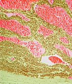 Gastric glomus tumour,light micrograph