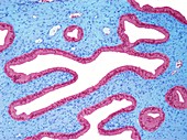 Endometriosis,light micrograph