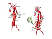 Graft implant to repair dissecting aorta
