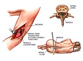 Lumbar puncture and radial nerve surgery